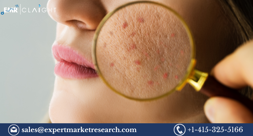 Global Severe Acne Vulgaris Treatment Market