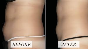 CoolSculpting