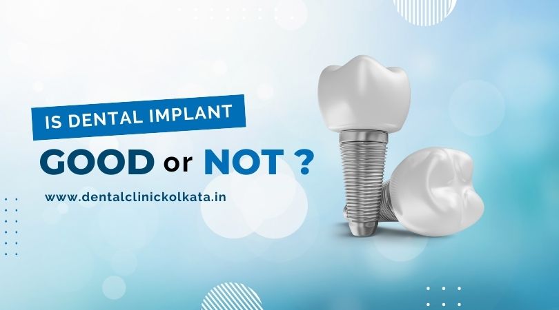 dental implants,dental implant clinic